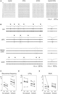 Synaptic alterations and neuronal firing in human epileptic neocortical excitatory networks